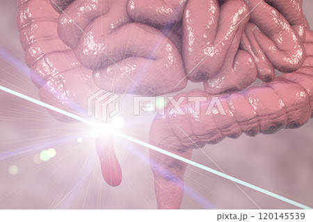 Acute appendicitis illustration 120145539