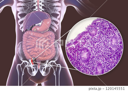 Acute suppurative appendicitis, illustration and light micrograph Acute suppurative appendicitis, illustration and light micrograph 120145551