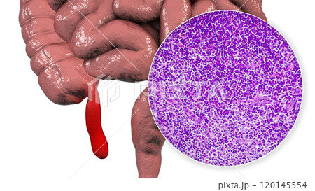 Acute suppurative appendicitis, illustration and light micrograph 120145554