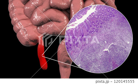 Acute suppurative appendicitis, illustration and light micrograph Acute suppurative appendicitis, illustration and light micrograph 120145555