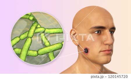 Cutaneous anthrax, the most common form of anthrax Cutaneous anthrax, the most common form of anthrax 120145720