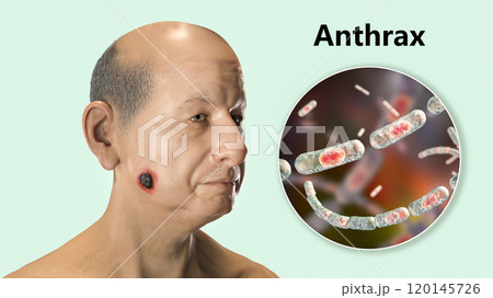 Cutaneous anthrax, the most common form of anthrax 120145726
