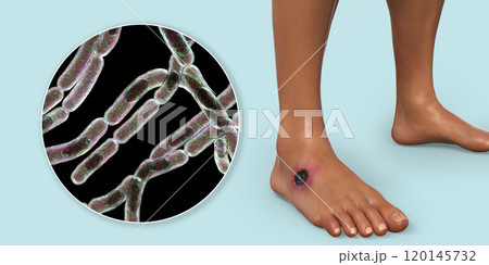 Cutaneous anthrax, the most common form of anthrax 120145732