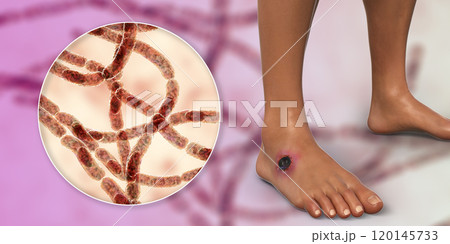 Cutaneous anthrax, the most common form of anthrax Cutaneous anthrax, the most common form of anthrax 120145733