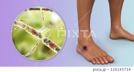 Cutaneous anthrax, the most common form of anthrax Cutaneous anthrax, the most common form of anthrax 120145734