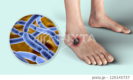 Cutaneous anthrax, the most common form of anthrax 120145737