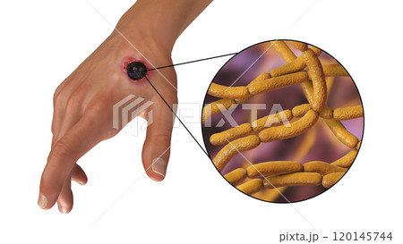 Cutaneous anthrax, the most common form of anthrax Cutaneous anthrax, the most common form of anthrax 120145744