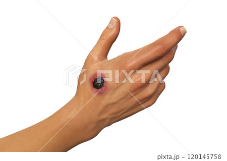 Cutaneous anthrax disease 120145758