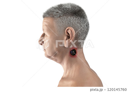 Cutaneous anthrax, the most common form of anthrax 120145760