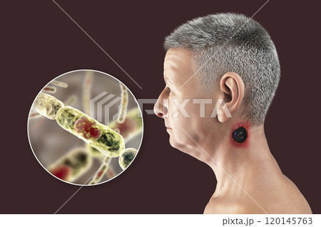 Cutaneous anthrax, the most common form of anthrax 120145763