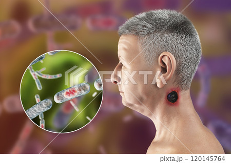 Cutaneous anthrax, the most common form of anthrax 120145764