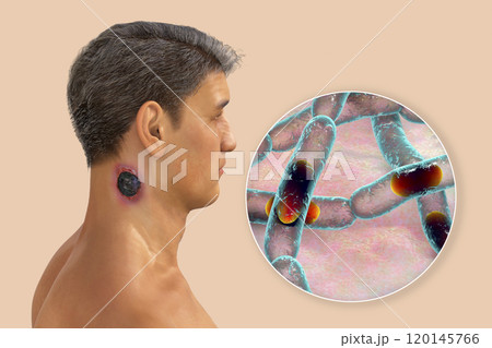Cutaneous anthrax, the most common form of anthrax 120145766