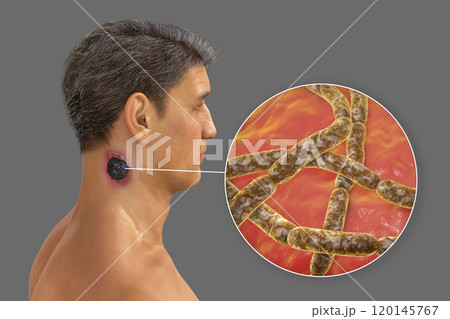 Cutaneous anthrax, the most common form of anthrax 120145767