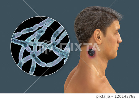 Cutaneous anthrax, the most common form of anthrax 120145768