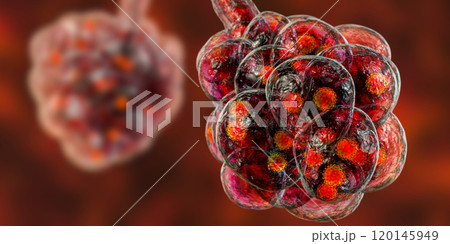 Coronavirus pneumonia, alveoli with Covid-19 Coronavirus pneumonia, alveoli with Covid-19 120145949