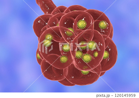 Coronavirus pneumonia, alveoli with Covid-19 Coronavirus pneumonia, alveoli with Covid-19 120145959