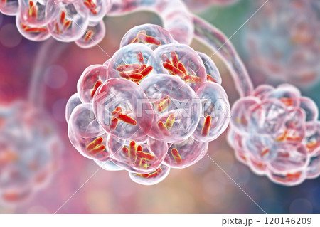 Bacterial pneumonia, medical concept 120146209