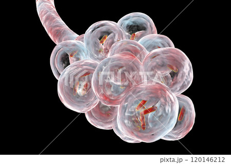 Bacteria pneumonia, medical concept 120146212
