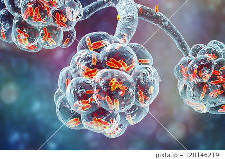 Bacterial pneumonia, medical concept Bacterial pneumonia, medical concept 120146219