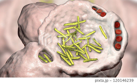 Bacterial pneumonia, medical concept 120146239