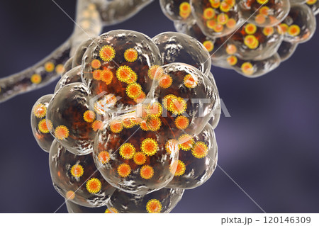 Coronavirus pneumonia, alveoli with Covid-19 120146309