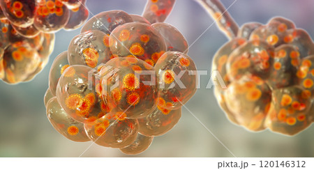 Coronavirus pneumonia, alveoli with Covid-19 Coronavirus pneumonia, alveoli with Covid-19 120146312