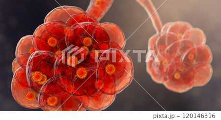 Coronavirus pneumonia, alveoli with Covid-19 120146316