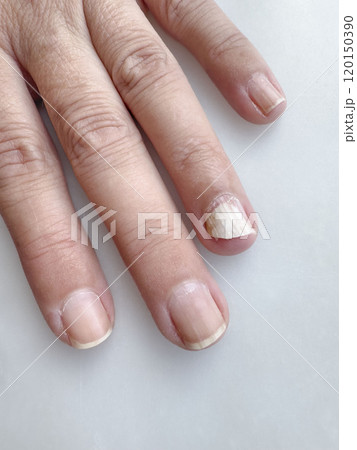 nail fungus infection on hand finger of woman 120150390