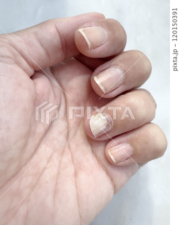 closeup hand with separation of flesh from nail. nail fungus 120150391