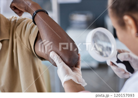 Close up of unrecognizable dermatologist examining skin with magnifying glass during consultation in clinic copy space Close up of unrecognizable dermatologist examining skin with magnifying glass during consultation in clinic copy space 120157093