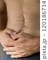 A person exhibits visible surgical scars on their torso, indicating a recent medical operation, highlighting the healing process and resilience of the human body. intestinal surgery 120186734