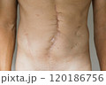 A male subject stands upright, revealing a prominent abdominal incision scar. The background is neutral, focusing on the scar that reflects recent surgery. 120186756
