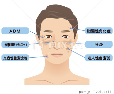 中年男性　シミ　名称　美容　老化 120197511