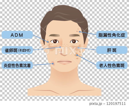 中年男性　シミ　名称　美容　老化 120197511