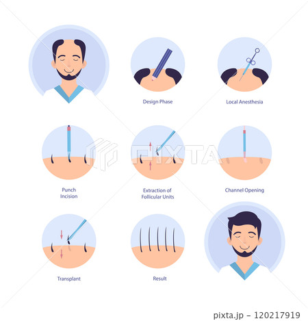 Cartoon Color Hair Transplantation Process Alopecia and Hairloss Treatment Infographic Concept Flat Design Style. Vector illustration Cartoon Color Hair Transplantation Process Alopecia and Hairloss Treatment Infographic Concept Flat Design Style. Vector illustration 120217919
