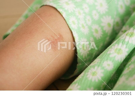 Stitched wound mark on a child foot. Stitched wound mark on a child foot. 120230301