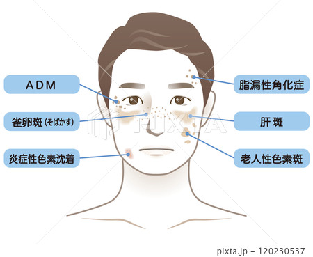 中年男性　シミ　名称　美容　老化 120230537