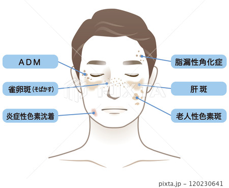 中年男性 シミ 名称 美容 老化 中年男性 シミ 名称 美容 老化 120230641