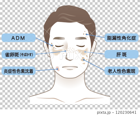 中年男性 シミ 名称 美容 老化 中年男性 シミ 名称 美容 老化 120230641