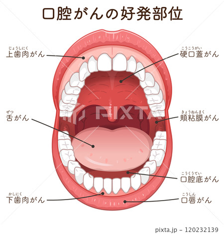 口腔がんの好発部位のイラスト　oral cancer illustration 120232139