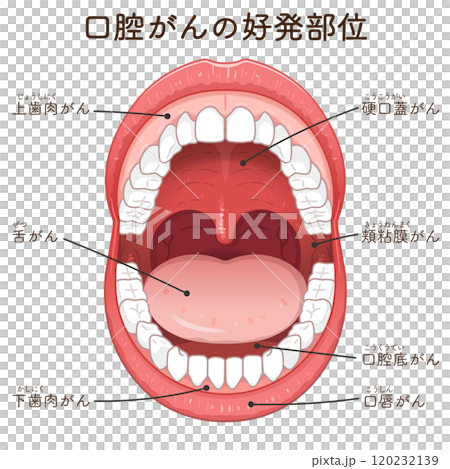 口腔がんの好発部位のイラスト　oral cancer illustration 120232139
