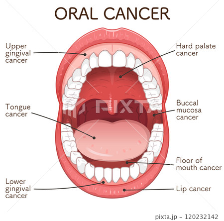 口腔がんの好発部位のイラスト oral cancer illustration 口腔がんの好発部位のイラスト oral cancer illustration 120232142