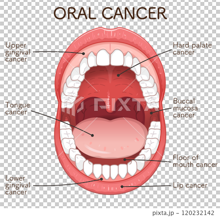 口腔がんの好発部位のイラスト oral cancer illustration 口腔がんの好発部位のイラスト oral cancer illustration 120232142