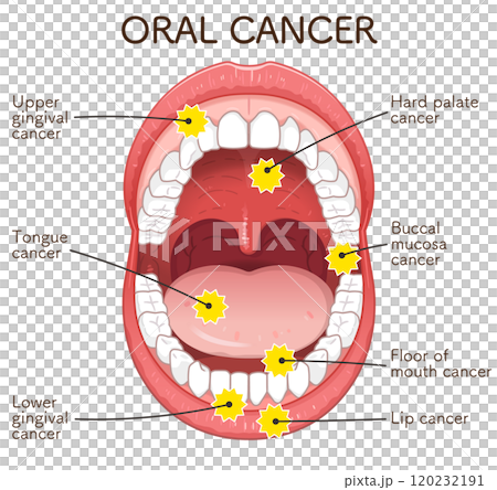 Oral cancer illustration Oral cancer illustration 120232191