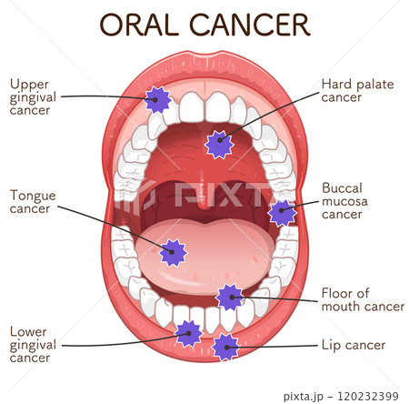 口腔がんの好発部位のイラスト oral cancer illustration 口腔がんの好発部位のイラスト oral cancer illustration 120232399