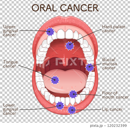 Oral cancer illustration 120232399