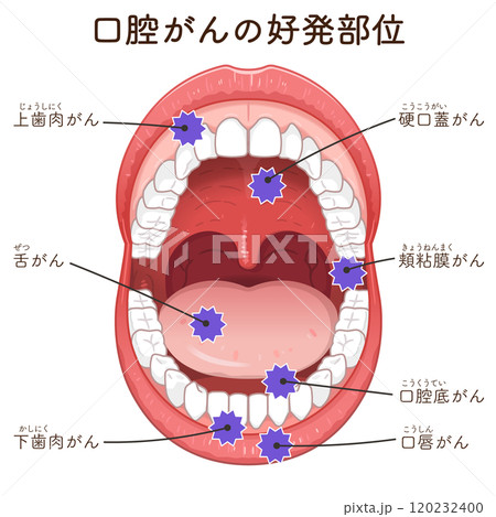 口腔がんの好発部位のイラスト　oral cancer illustration 120232400