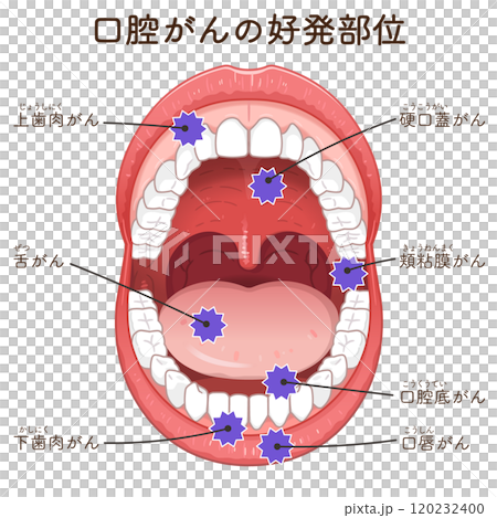 口腔がんの好発部位のイラスト　oral cancer illustration 120232400