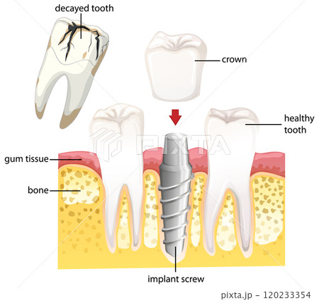 Dental Implant Procedure Illustration 120233354