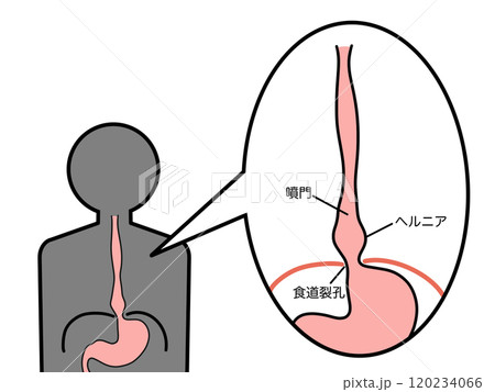 食道裂孔ヘルニア 滑脱型 文字あり 食道裂孔ヘルニア 滑脱型 文字あり 120234066